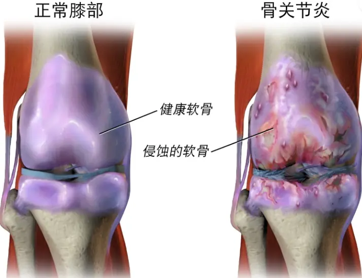 类风湿性关节炎